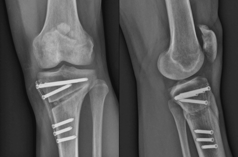 Osteotomia kolana co to jest