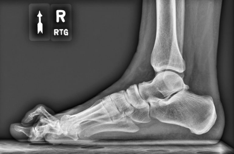 Palec młotkowaty stopy