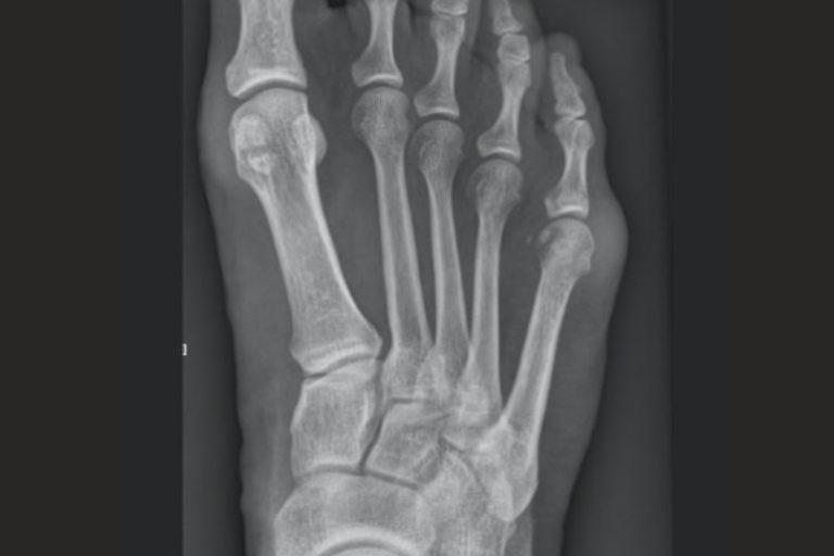 Bunionette (kostka krawca)